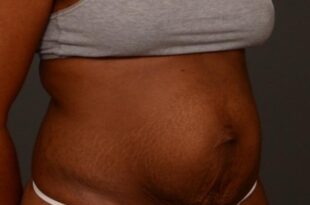 All about postpartum diastasis recti and how to get rid of it
