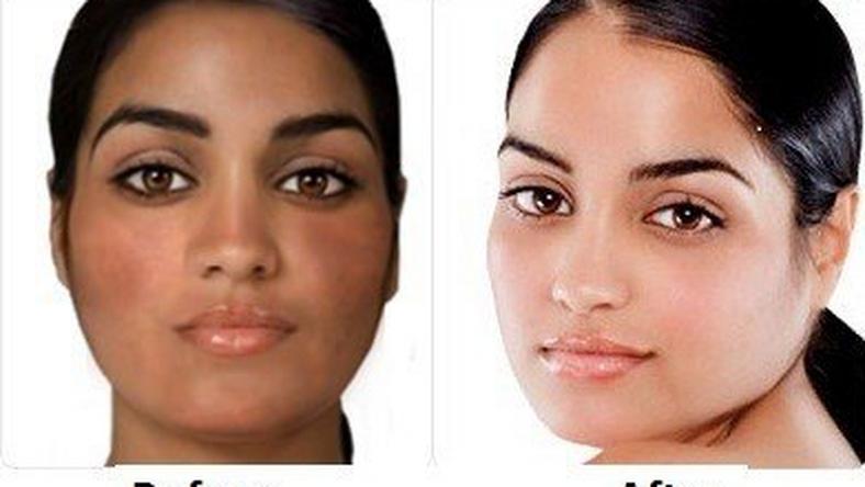 Here's all the ways bleaching destroys your skin and health