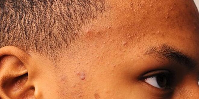 Here's why your skin keeps experiencing acne breakout