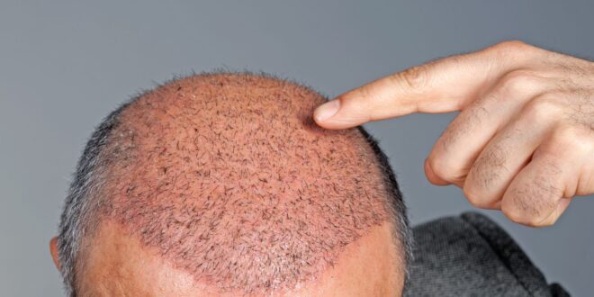 All You Need To Know About Hair Transplantation In Numbers | The Guardian Nigeria News - Nigeria and World News