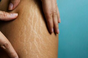 Natural Remedies: How to remove stretch marks naturally