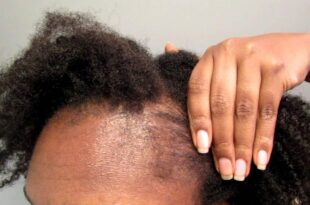 4 natural ways women can regrow hair on their bald head