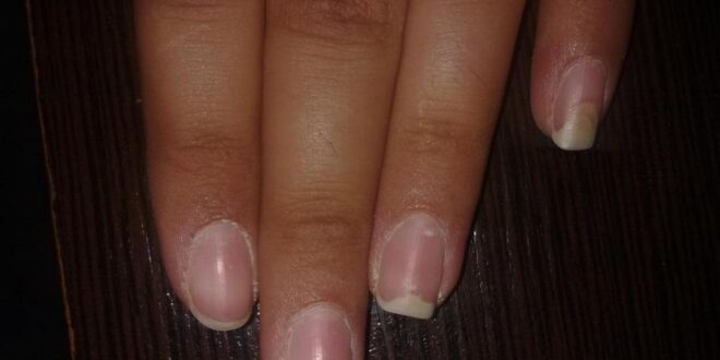 Causes and treatment of fingernails falling off