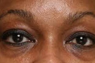 4 ways to treat dark eyes circle under your eyes