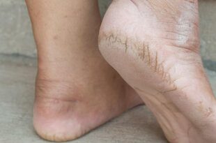 5 home remedies to cure cracked heels