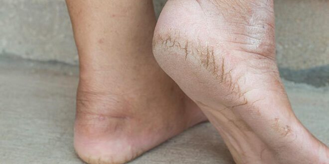 5 home remedies to cure cracked heels