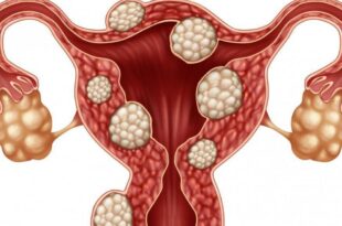 Fibroids: Everything you need to know about these non-cancerous tumours