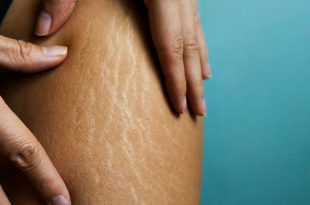 5 homemade remedies for stretch marks