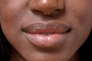 3 ways to prevent dry lips