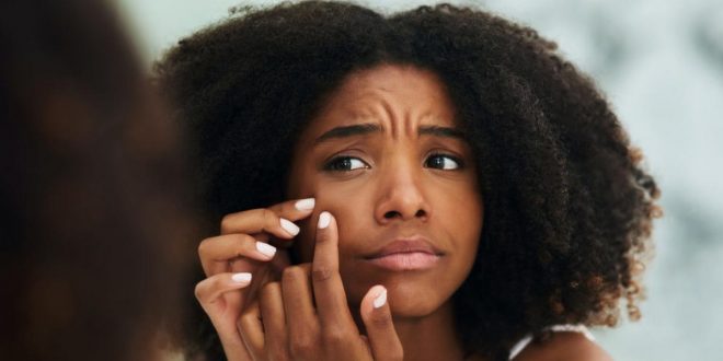 7 Skincare mistakes that are causing your Acne