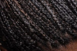 Natural Hair Girl: 5 ways to deal with dandruff naturally