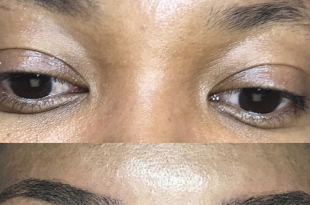 5 risks associated with microblading your eyebrows