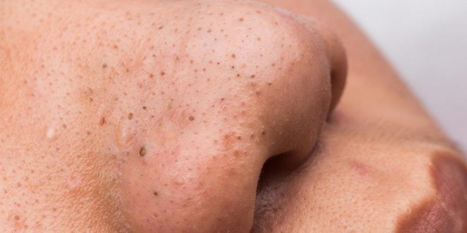 Beauty tips: Safe and effective ways to remove deep blackheads