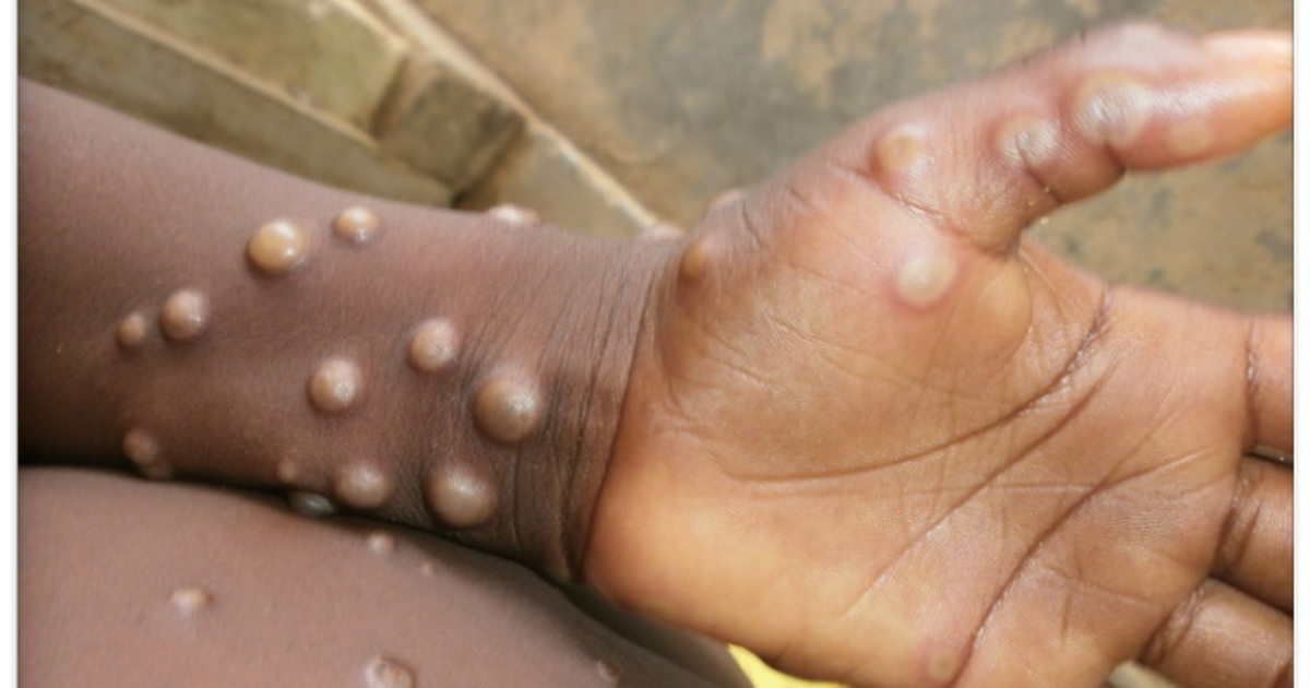 5 things you need to know about Monkeypox