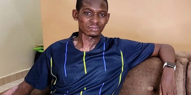 "It was the most agonising experience of my life" - Nigerian man who survived gas explosion shares his ordeal