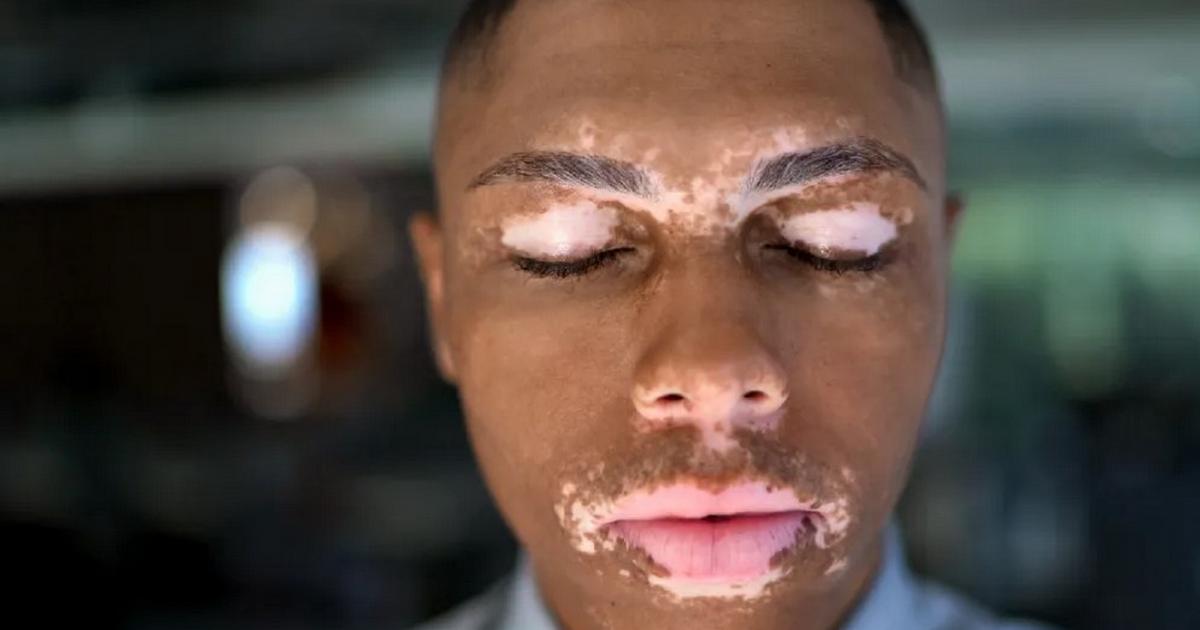 8 Common myths and facts about Vitiligo