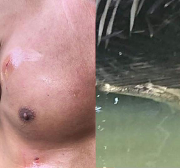 Brave man narrates how he survived crocodile attack after the reptile bit into his skin