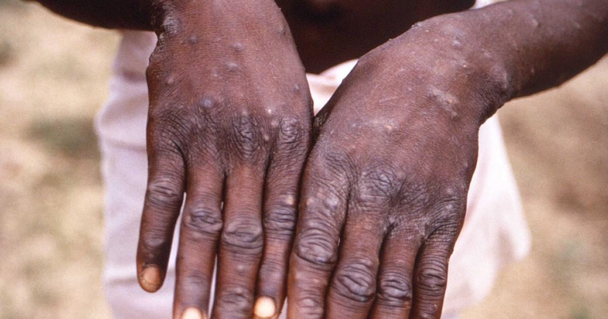 Monkeypox: Nigeria records 10 additional cases in 7 days - NCDC