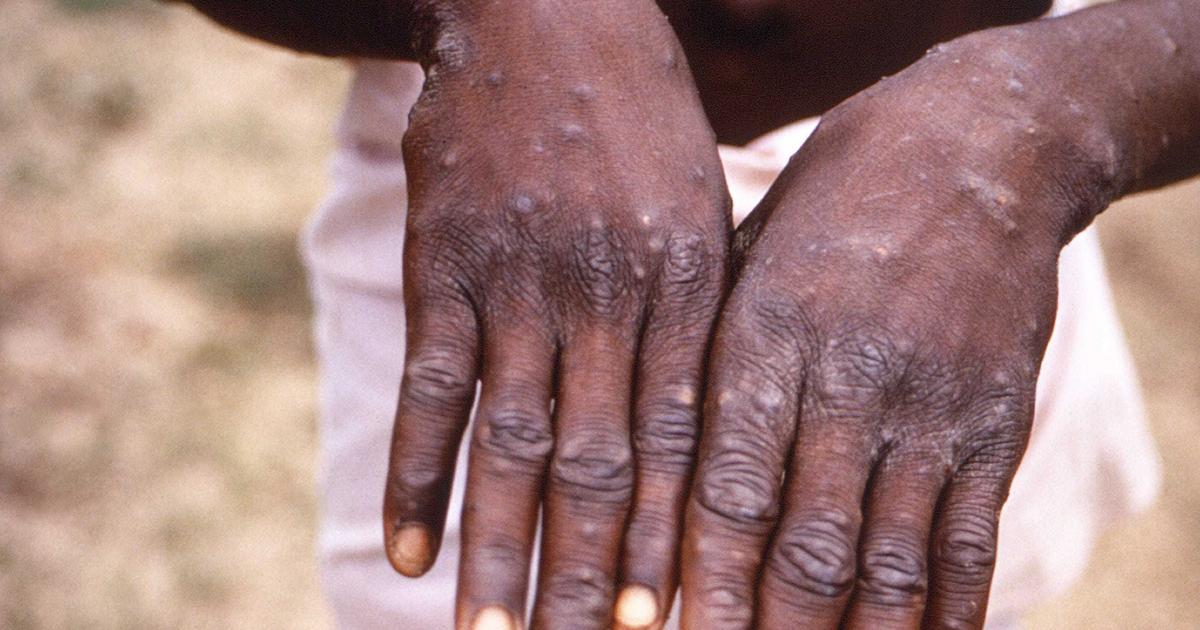 Monkeypox: You may need nose masks to protect yourself from the virus