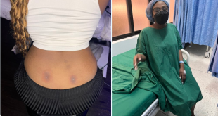 Lady lands in the hospital after getting a back dimple piercing