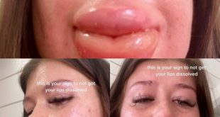 "This is your sign to not get your lips dissolved" Woman warns as severe reaction to filler dissolvent causes her lips to balloon
