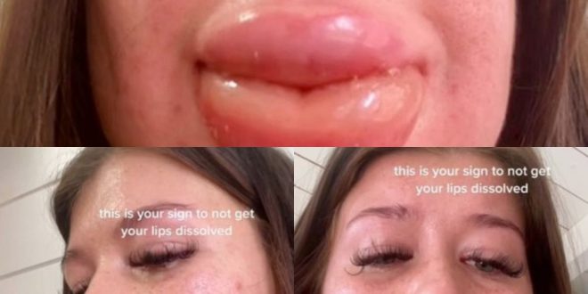 "This is your sign to not get your lips dissolved" Woman warns as severe reaction to filler dissolvent causes her lips to balloon