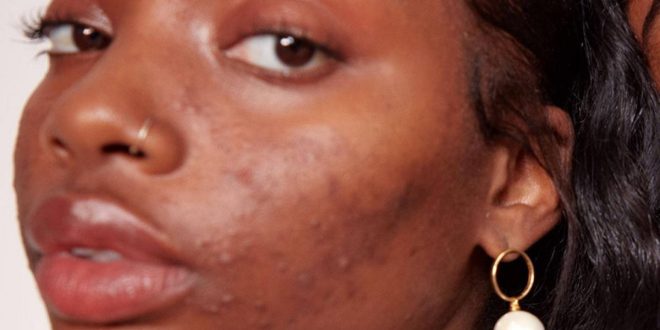 5 reasons you have acne as an adult