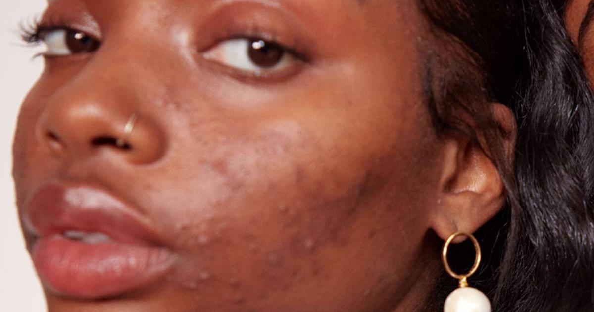 5 reasons you have acne as an adult