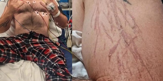 Man struck by lightning while playing video games in his living room survives with burn stripes on arms