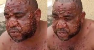 Nigerian man suffering from Monkey Pox narrates how he was misdiagnosed by multiple doctors as he opens up about the ailment (video)