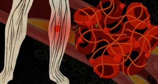 If You’re Being Treated For Cancer, Don’t Neglect The Risk Of Blood Clots