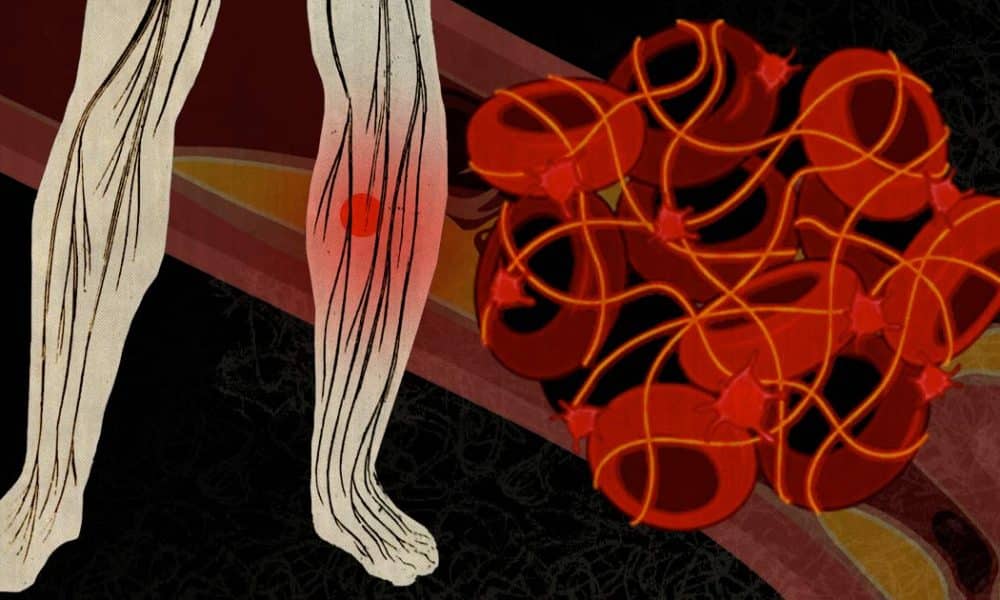 If You’re Being Treated For Cancer, Don’t Neglect The Risk Of Blood Clots