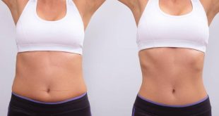 Liposuction offers six benefits