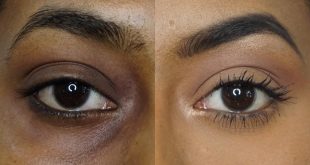 5 natural remedies for dark circles under the eyes