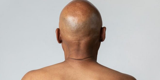 Scientists in Japan might have found a cure for baldness