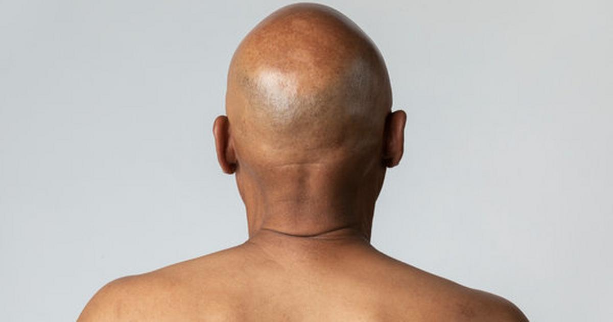 Scientists in Japan might have found a cure for baldness