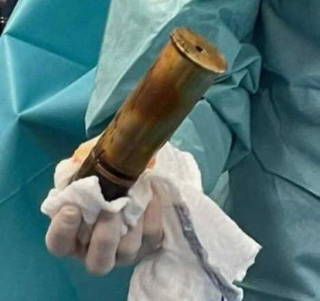 Elderly man shows up at emergency room with World War 1 bomb up his bum