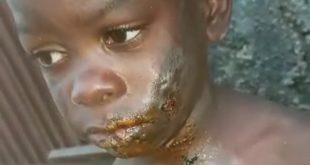 Boy left with serious burns after he was physically abused by his aunt in Imo State (video)