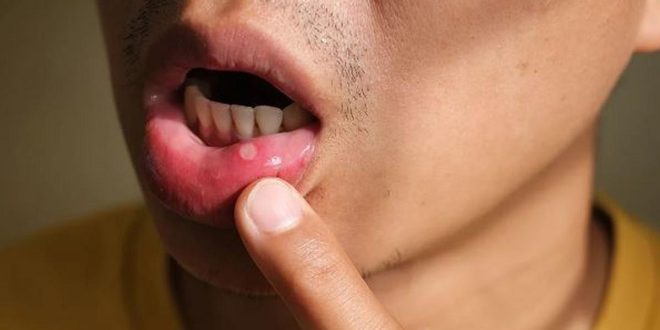 Mouth ulcers: 4 home remedies to treat sore in the mouth