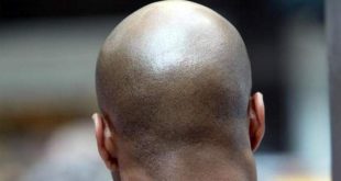 New study shows energy drinks may lead to baldness in men