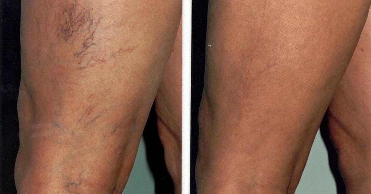 5 simple things spider veins are telling you to do