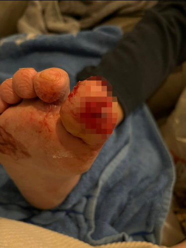 Man wakes to find his puppy has chewed his big toe to the bone but it saved his life