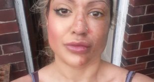 Mum left with skin peeling off her face after egg exploded during TikTok challenge