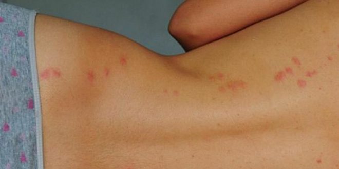 3 unbelievable reasons mosquitoes are more attracted to you than others