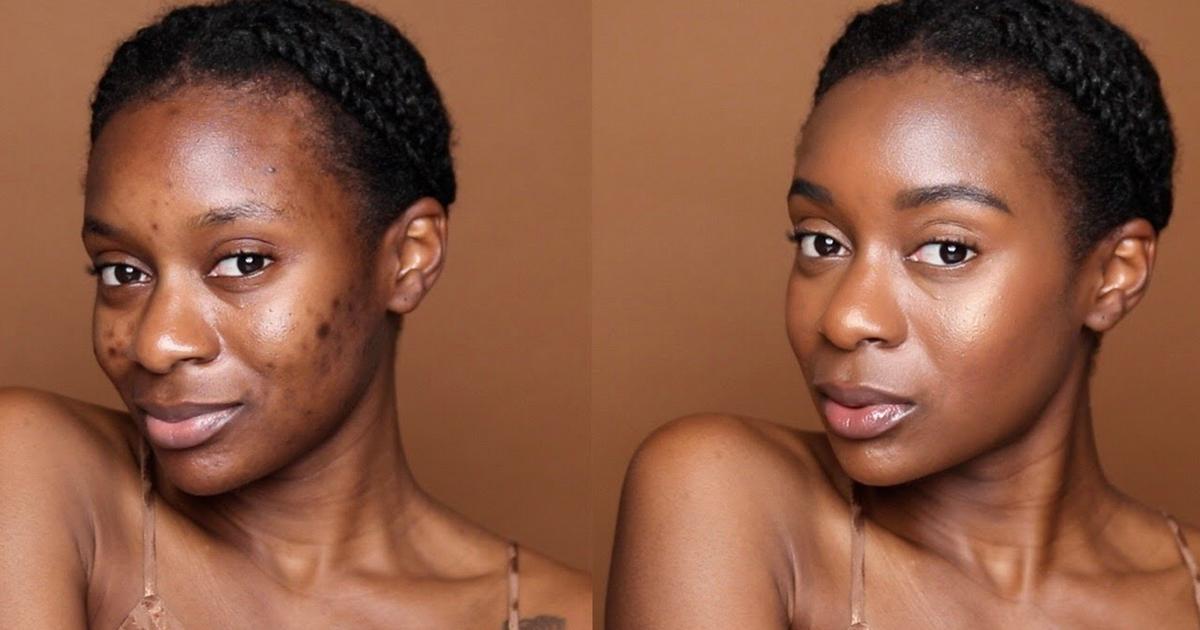 5 mistakes to avoid when you want to hide your pimples