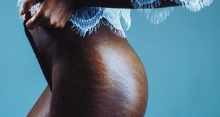 5 natural products you can use to slowly get rid of stretch marks
