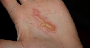Blisters: How they form & why you shouldn’t pop them, according to AI