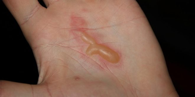 Blisters: How they form & why you shouldn’t pop them, according to AI
