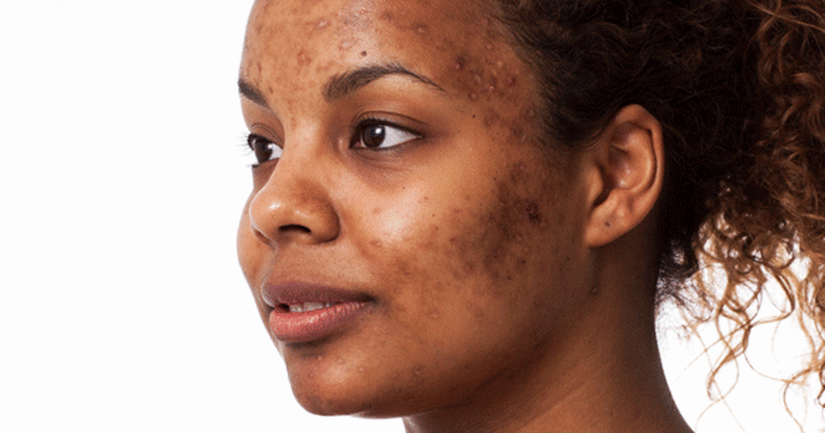 How Nigerian skincare merchants were exposed for damaging people's skin
