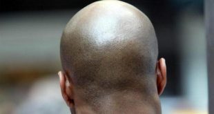 Aside from genetics, these are 12 things that can cause baldness